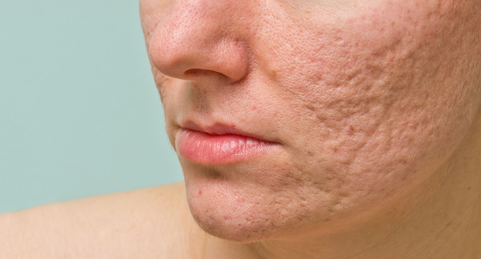 Needling si può usare per acne?