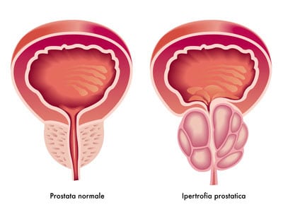 Prostata ingrossata : sintomi e rischio